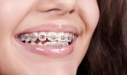 5 Most Common Myths About Braces-photo