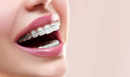 Your Guide to Clear Braces-photo